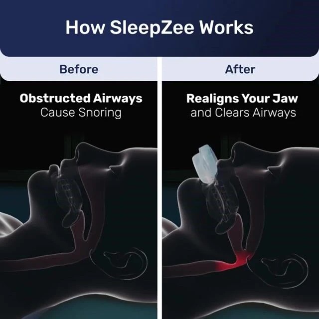 Official SleepZee image showing the jaw position before and after the mouthpiece